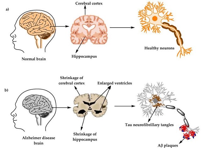 الشكل (1): التركيب الفسيولوجي للدماغ والخلايا العصبية في (أ) الدماغ السليم و(ب) دماغ مريض الزهايمر [3].